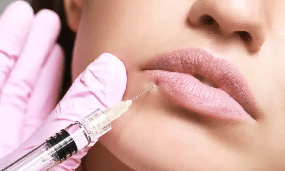 Expert Lip Fillers Tips For Fuller, Plumper Lips